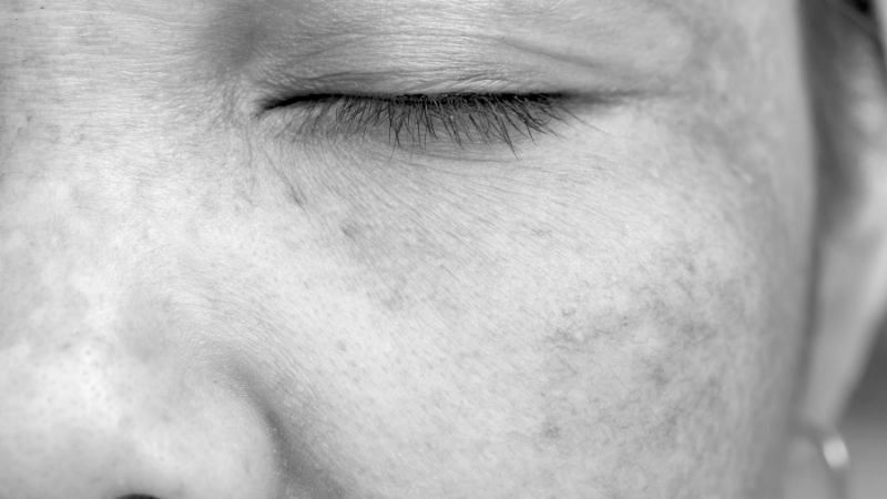 Sun Damaged skin treatment - book an appointment today Peterborough