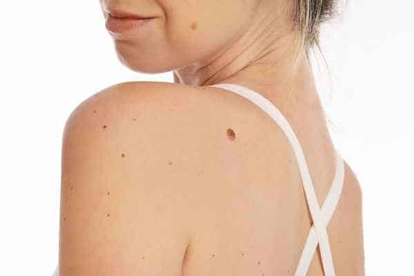 Why Professional Skin Tags Removal Is Better Than DIY Methods in Peterborough