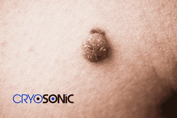 Looking for non surgical Dermatofibroma removal Peterborough? Contact us today Peterborough