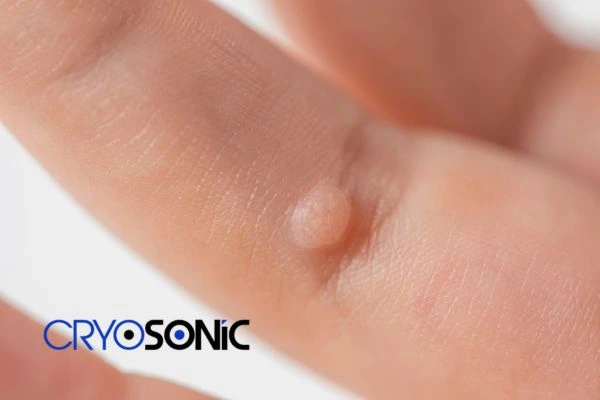 Contact Cryosonic today to learn more about us Peterborough now! Peterborough