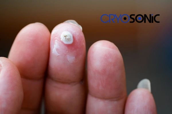 Learn more about us Peterborough at Cryosonic. Book in today! Peterborough
