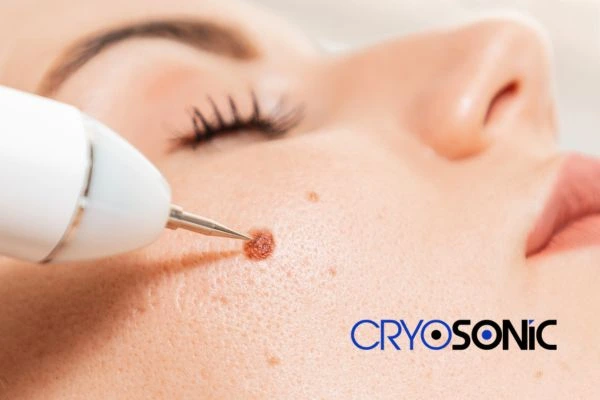 why choose us at Cryosonic for blemish removal? Find out more now Peterborough