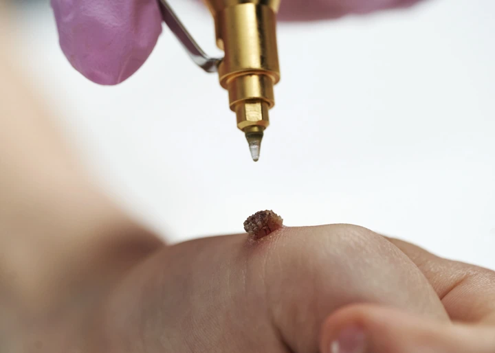 Cryopen For Children Bristol Peterborough