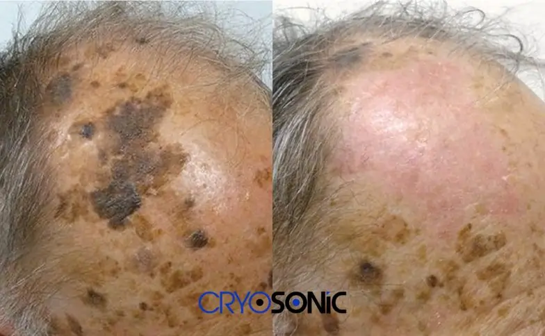 Seborrhoeic Keratosis Removal before and after Peterborough