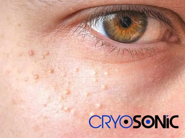 Cryosonic&rsquo;s CryoPen Approach to Milia Removal Peterborough Peterborough