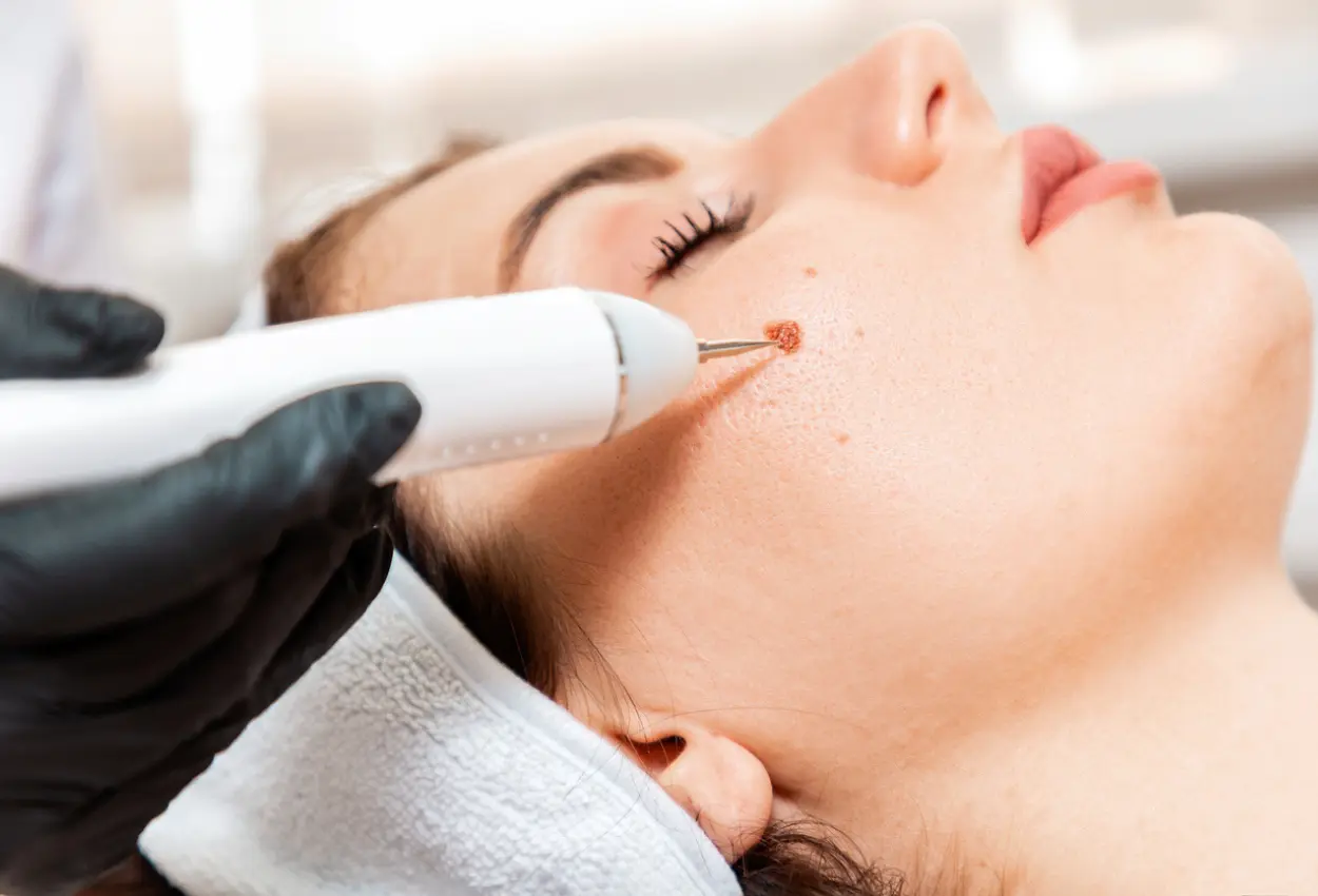 Frequently Asked Questions About Multiple Cryotherapy Treatments Peterborough