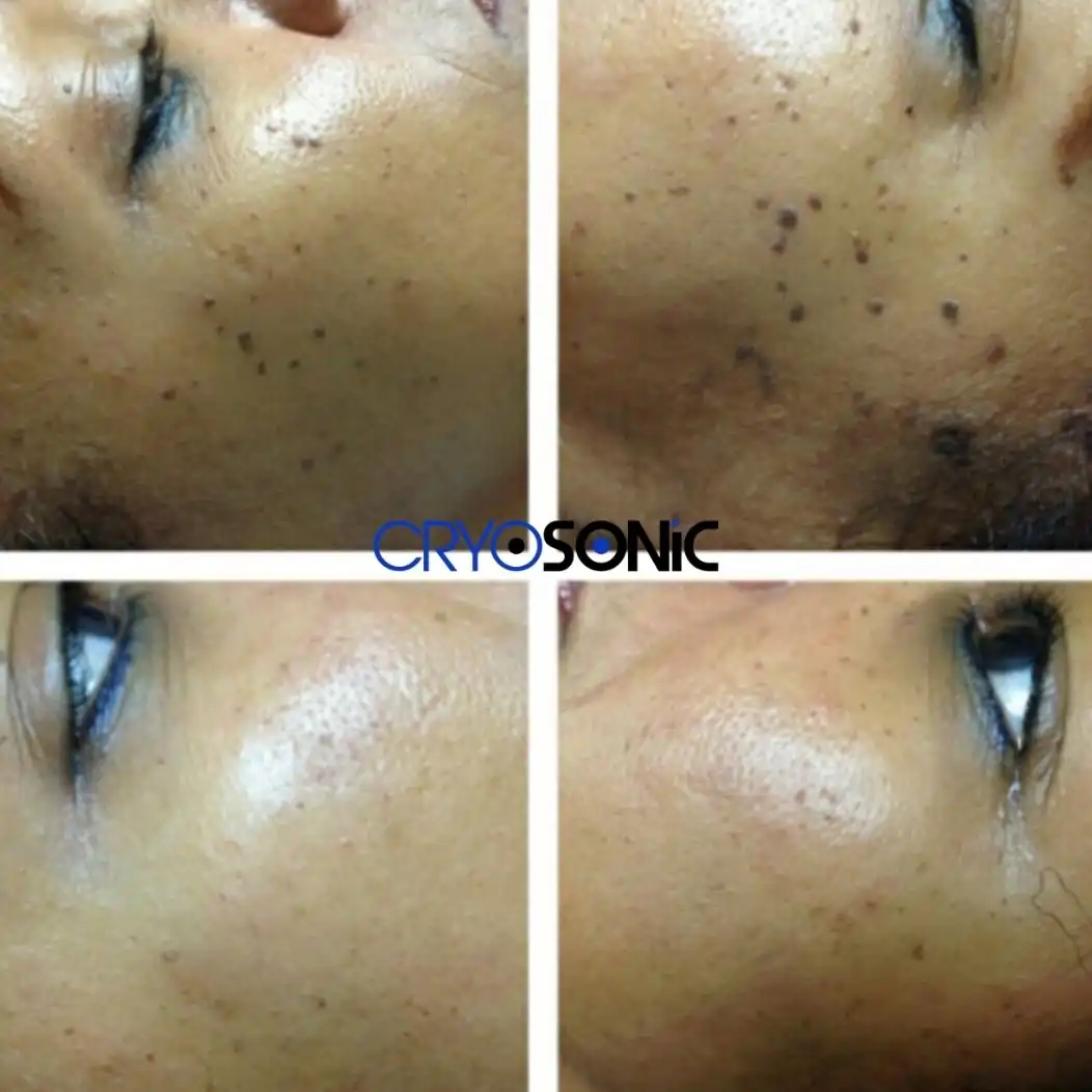 Why Skin Shows Pigmentation After Treatment Peterborough
