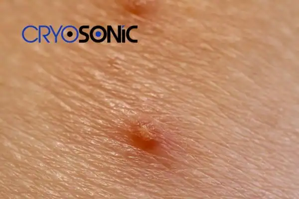 Molluscum Contagiosum Treatment Peterborough Peterborough