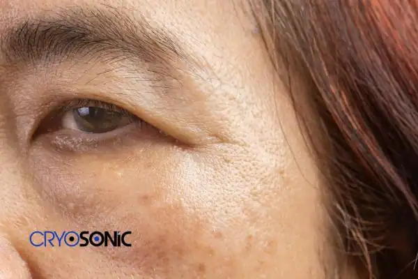 Image of age spot treatment Peterborough Peterborough