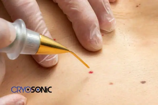 Image of cherry angioma removal Peterborough Peterborough