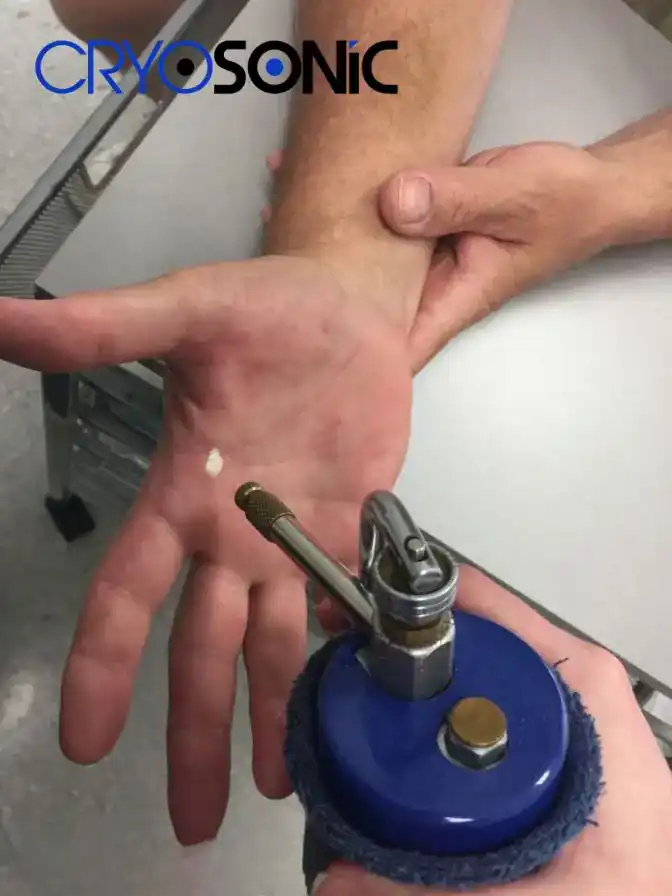 Temperature Differences: OTC vs Medical-Grade Cryotherapy Peterborough